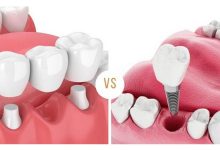 بریج دندان بهتر است یا ایمپلنت؟