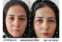 معتبر ترین کلینیک درمان افتادگی پلک در تهران
