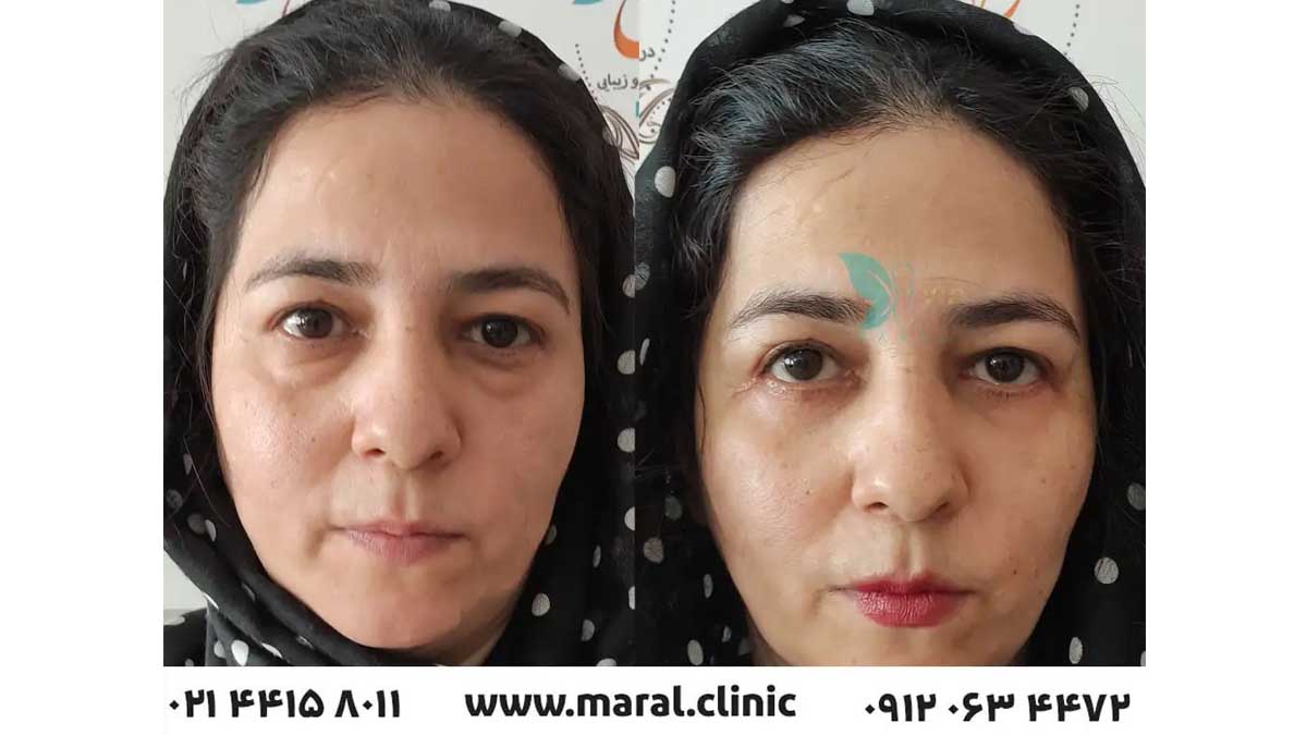 معتبر ترین کلینیک درمان افتادگی پلک در تهران
