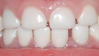 آیا دندان شیری هم عصب دارد؟