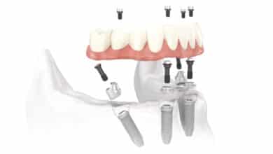 ایمپلنت های دندان از چه موادی ساخته شده اند؟
