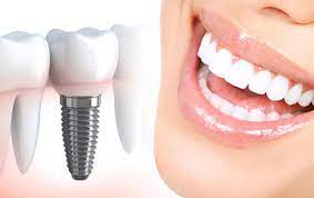 ایمپلنت دندان در چه مواردی انجام می شود؟