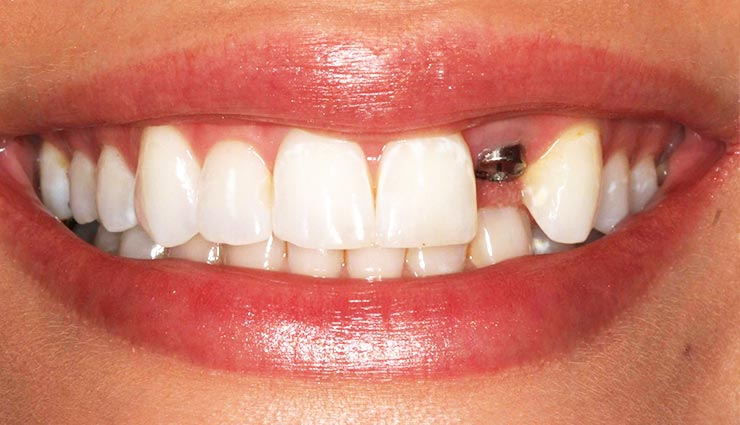 معایب ایمپلنت دندان