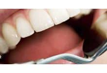 مراحل ساخت ایمپلنت دندان چیست؟ | روکش زیرکونیا