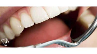 مراحل ساخت ایمپلنت دندان چیست؟ | روکش زیرکونیا